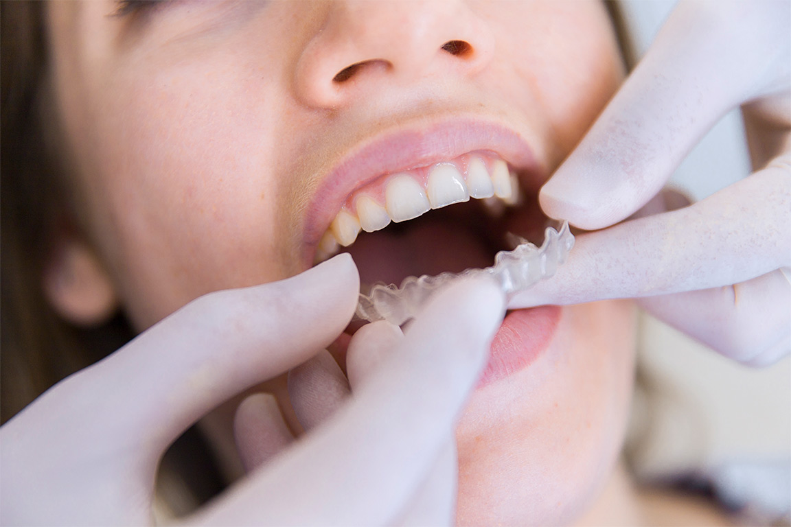 ortodoncia-invisalign-clinica-dentality-talavera