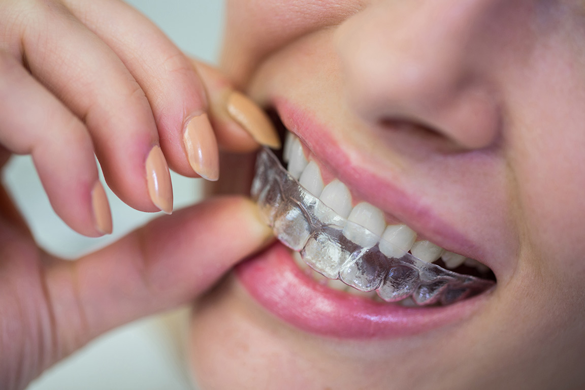 ortodoncia-invisible-tipos-y-tratamientos-clinica-dental-en-talavera